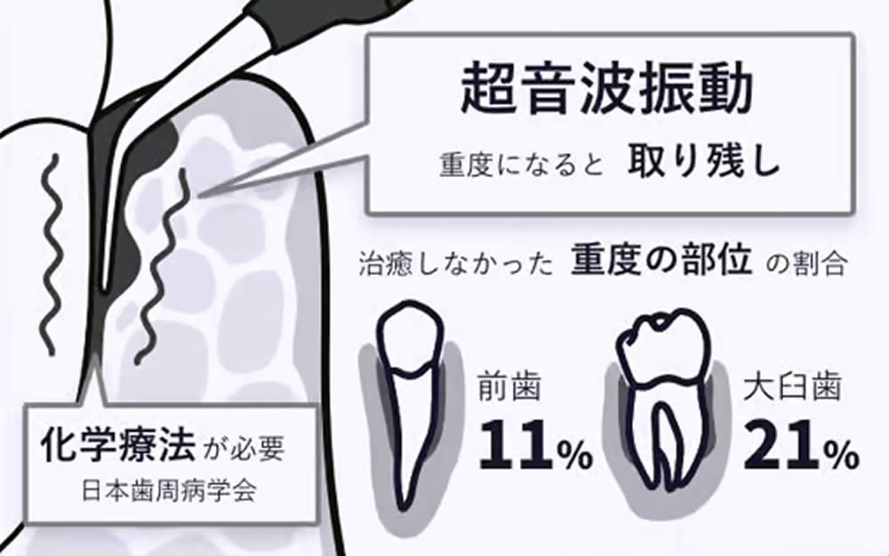 従来の歯周病治療