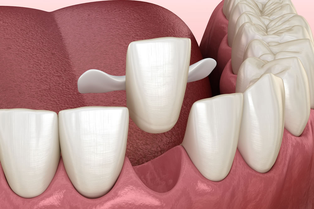 ダイレクトブリッジ